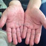 Coxsackie virus - lahat tungkol sa paggamot ng hand-foot-mouth syndrome